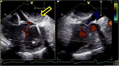 Case Report: Left atrial dissection after mitral valve replacement: intraoperative management under TEE guidance